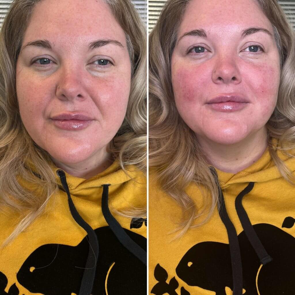 Dermal Fillers In Ottawa, ON Skin Logic Ottawa