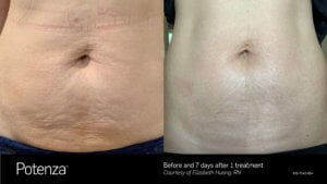 Potenza | Before and After Treatment SKINLOGIC | Skinlogicottawa | Ottawa