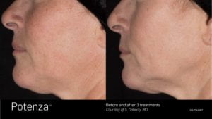 Potenza Before and After 3 Treatments | SKINLOGIC | Skinlogicottawa | Ottawa