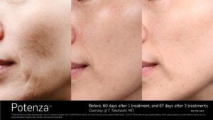 Potenza Before and After 1 & 2 Treatments SKINLOGIC | Skinlogicottawa | Ottawa