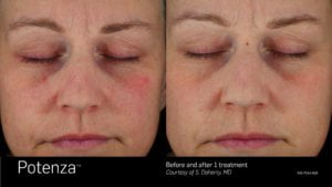 Potenza - Before and After Treatment SKINLOGIC | Skinlogicottawa | Ottawa