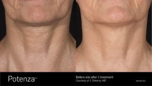 Potenza Before and After Treatment SKINLOGIC | Skinlogicottawa | Ottawa